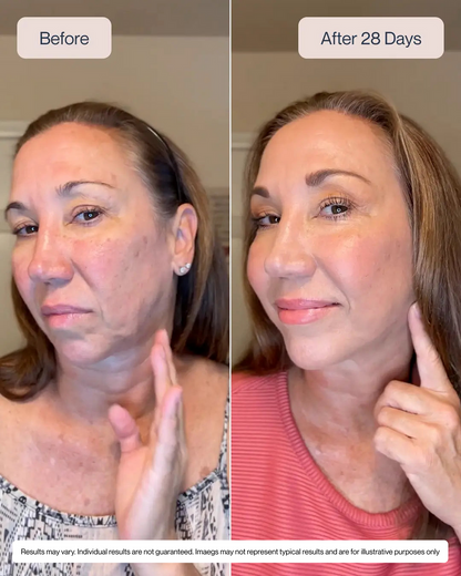 RenewaLift: The Vertical Lip Line Specialist